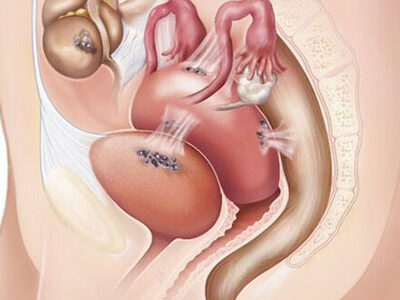 Expert endometriosis management and treatment at a women’s health clinic in Noida